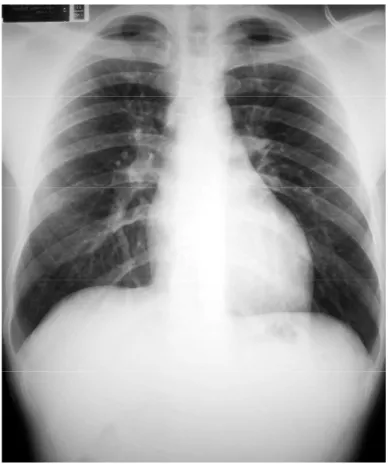 FIGURA 6 - Telerradiografia do tórax em PA mostrando equalização dos vasos pulmonares