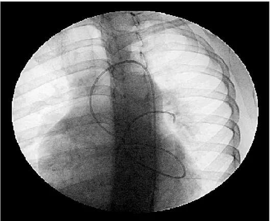 FIGURA 4 – Cateter em veia pulmonar esquerda por via retrógrada