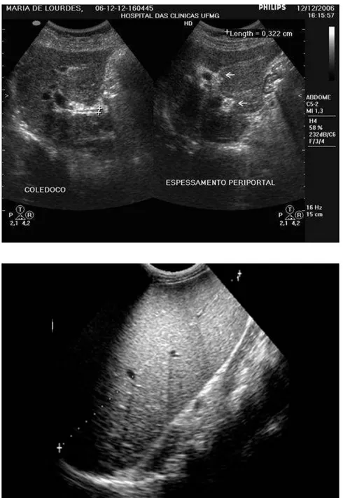 FIGURA 6 – Ultra-som em pacientes com esquistossomose hepatoesplênica.  A: Bandas hiperecogênicas ao longo dos tratos portais 