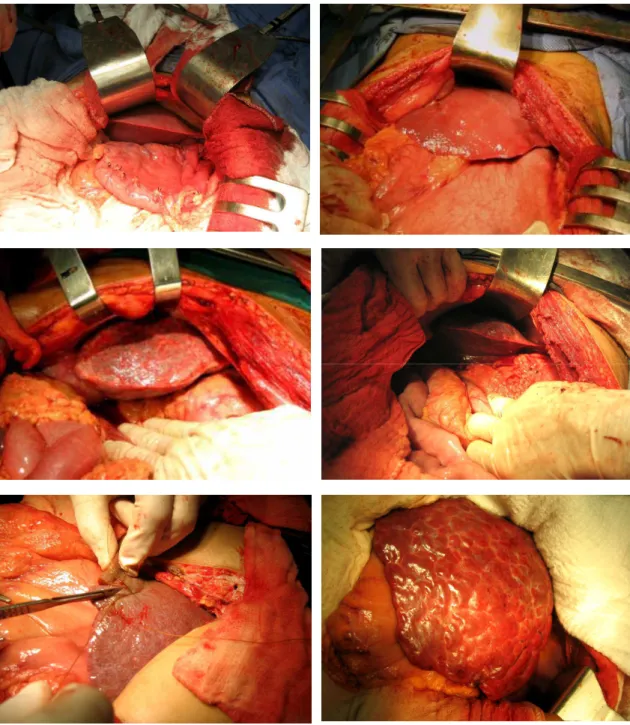 FIGURA 9 - Aspecto macroscópico do fígado em pacientes com esquistossomose  hepatoesplênica