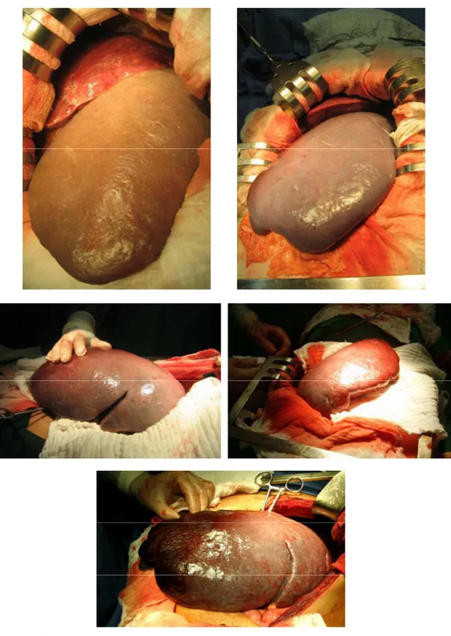 FIGURA 10 - Aspecto macroscópico do baço em pacientes com esquistossomose  hepatoesplênica