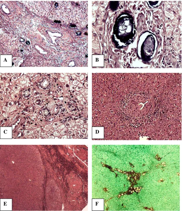 FIGURA 11 – Histologia hepática em pacientes com esquistossomose   hepatoesplênica. Lâminas coradas em HE e Picrossirius vermelho