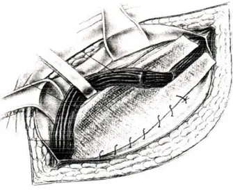 Figura 6: Técnica de Falci- Falci-Lichtenstein. Fixação da  prótese ao ligamento  inguinal