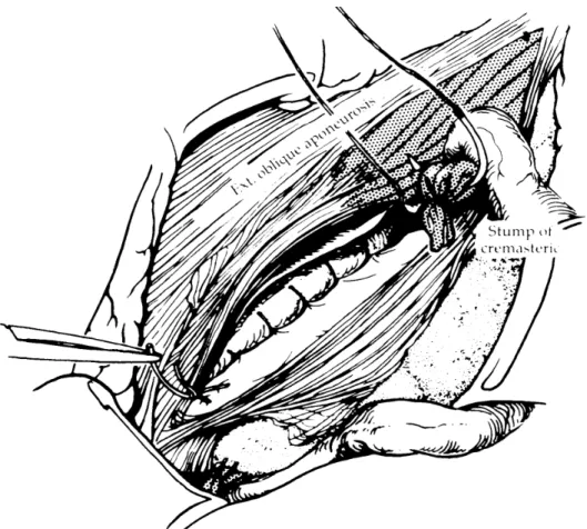 Figura 17: Técnica deShouldice modificada por Berliner. Término  do primeiro plano de sutura  
