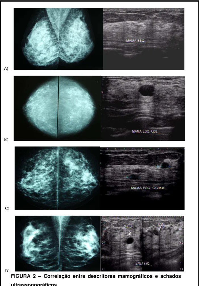 FIGURA  2  –  Correlação  entre  descritores  mamográficos  e  achados  ultrassonográficos 