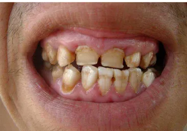 Figura 11: Fluorose dentária severa registrada em morador no município de Verdelândia, MG 