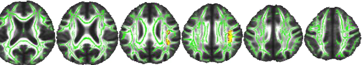 Figure 4. Association between white matter integrity and literacy 