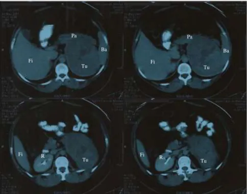 Figura 1. Topografia de tumor funcional gigante da glândula supra-renal esquerda, evidenciado por tomografia  computadorizada (TC)