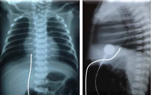 Figure 3 Trajectory of the umbilical venous catheter in chest radiography at the anteroposterior (left) and lateral (right) views.