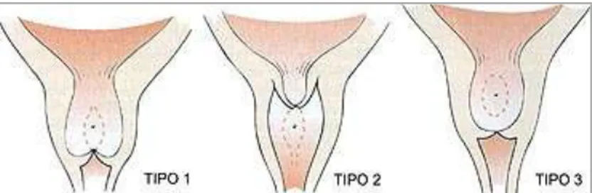 Figura 1. Uropatias obstrutivas severas em crianças. Tipo I: pregas mucosas que se estendem lateral e  distalmente  ao  verumontano,  presas  as  paredes  anterolaterais  da  uretra;  Tipo  II  e  III  representam  hipertrofia das pregas coliculares proxim