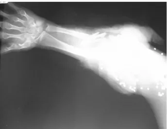 Figure 2 - Massive musculoskeletal trauma