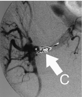 Figura 1 - Imagen angiográfica durante embolización de la arteria hipogástrica, C muestra los coils instalados en el tronco del vaso previo al nacimiento de sus primeras ramas