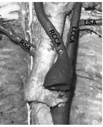Figure 7 - Aortic arch variations, case VI