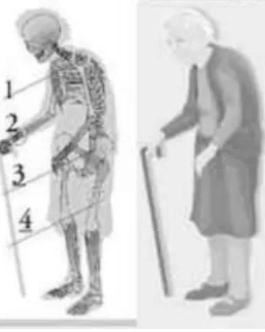 Figura  3:  Esquema  de  fraturas  mais  comum  ocorridas  entre  os  idosos.  Fonte:  HOSPITAL  SANTA  LUCIA,  online, 2006