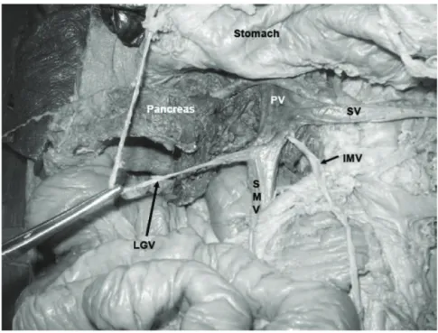 Figure 1 - Dissection of the abdomen showing formation of the portal vein by three veins