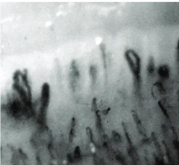 Figure 1 - Detail of the nailfold capillaroscopy showing the so called “scleroderma pattern,” characterized by irregularly enlarged loops (giant capillaries) and loop dropout areas, typical of systemic sclerosis