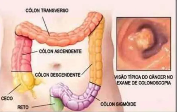 Figura 1. Anatomia do intestino grosso e visão típica do câncer no exame de colonoscopia