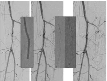 Figure 1 - Stenting currently remains reserved for subopti- subopti-mal percutaneous transluminal angioplasty: A)  pre-operative angiographic imaging shows lesion at the level of the tibiofibular trunk, which is B)  subopti-mally treated with percutaneous 