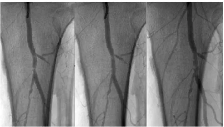 Figure 6 - Angiographic control of a A) 80% stenosis of the tibiofibular trunk, with B) 5% residual stenosis after AMS (Biotronik AG, Bülach, Switzerland) implantation and C) 36% in-stent restenosis at 6 months after index procedure