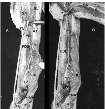 Figure 1 - Deep structures of posterior leg compartment are revealed by reflecting the soleus muscle upwards and laterally and the tibial nerve medially: A) the popliteal artery entry site is deep to soleal arch, and its bifurcation to peroneal artery and 