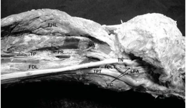 Figure 2 - Structures passing beneath the flexor retinaculum to the sole: the photograph shows continuation of peroneal artery as lateral plantar artery of sole