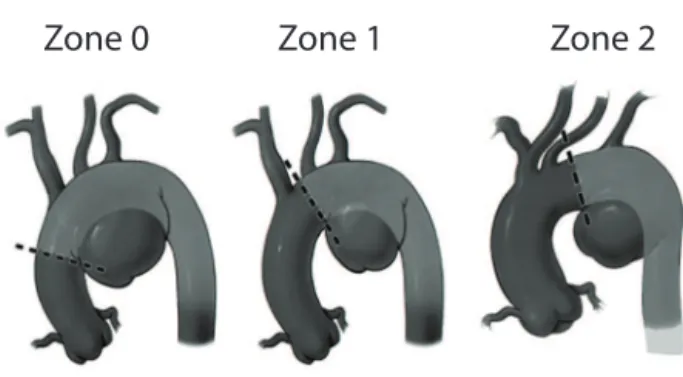 Figure 1 - Ishimaru classification of proximal landing zones