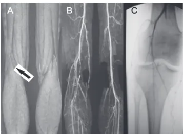 Figure 1 - A) Magnetic resonance showing Rich’s type 3 entrapment (arrow); B) resonance with right popliteal artery occlusion; C) arteriogram  confirm-ing right popliteal artery occlusion