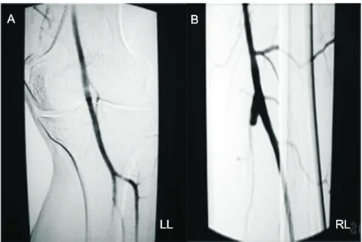 Figure 3 - A) Arteriogram after surgery demonstrating normal left popliteal artery at stress maneuvers; B) occlusion of right saphenous vein bypass