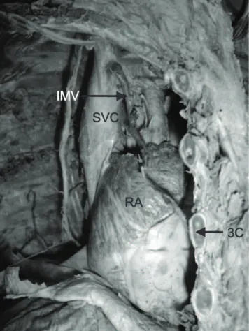 Figure 1 - Right internal mammary vein draining into superior vena cava