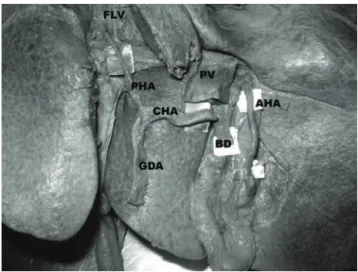 Figure 2 - Hepatic and accessory hepatic arteries arising from the celiac trunk and the superior mesenteric  arter-ies, respectively