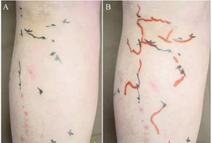 Figure 3 - A) Veins marked by traditional method; B) vein marked by TcPh