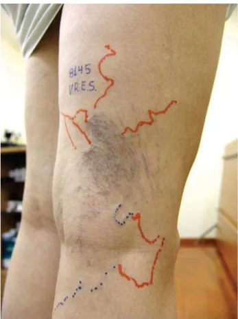 Figure 4 - Draining reticular veins of complex telangiectasias identified by TcPh