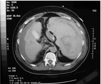 Figure 1 - Image from CT scan showing a grossly abnormal spleen with a large amount of free fluid in the abdominal cavity