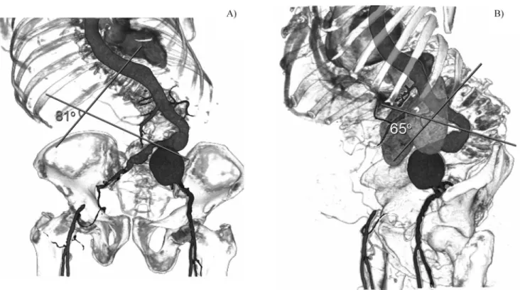 Figure 1 - Three-dimensional reconstruction of preoperative CT scan with OsiriX software 12 showing the left common iliac aneurysm, oc- oc-clusion of the right common iliac artery and vicarious collateral circulation