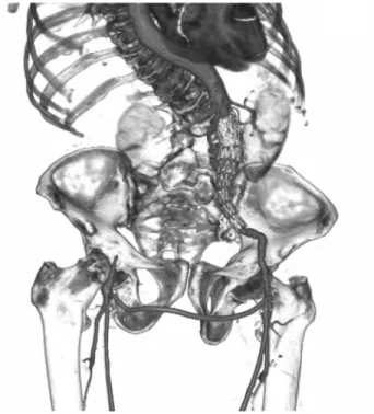 Figure 2 - Three-dimensional reconstruction of postoperative CT scan with OsiriX software showing left endograft and femoro-femoral bypass graft patency, right iliac occlusion and complete exclusion of common iliac aneurysm