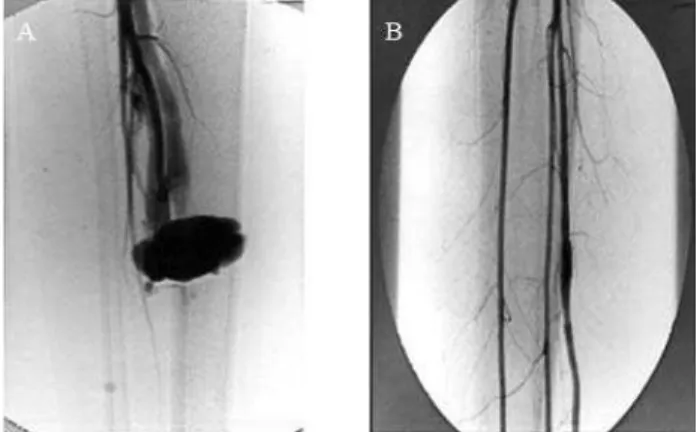 Figura 1 - Case 1: A) diagnostic arteriography; B) angiographic control