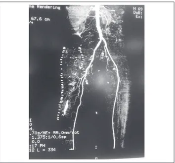 Figure 4 – Right external iliac artery grafted.