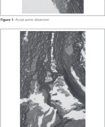 Figure 2 - Acute aortic dissection presenting rupture of vasa vasorum