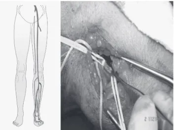 Figure  1  –  Great  saphenous  vein  in  anastomosis  end-to-side  to  the  best donor artery.
