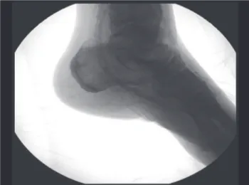 Figure 6 – Postoperative angiography showing fulillment of the plantar  arch of the foot and of the small saphenous vein