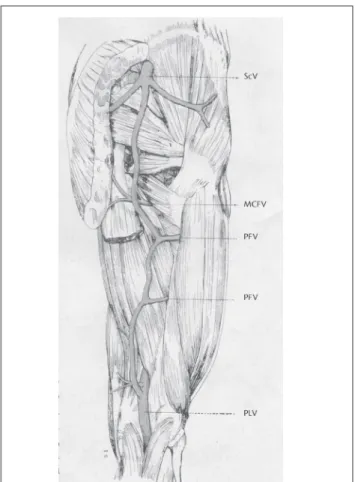 Figure 2 – (A) Complete persistent sciatic vein; (B) proximal persistence  of the sciatic vein; (C) distal persistence of the sciatic vein.