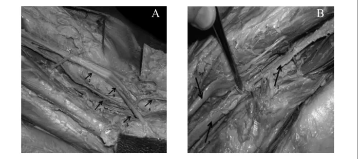 Figure 3 – (A) Sciatic vein on the left lower limb: (1) sciatic vein; (2) sciatic nerve; (3) popliteal vein; (4) small saphenous vein; (5) common ibular nerve