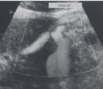 Figure 1 – Color Doppler ultrasound demonstrating celiac artery dila- dila-tation