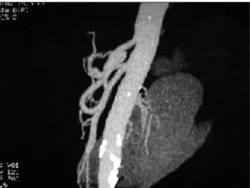 Figure 5 – CT Angiography: absence of aortic dissection