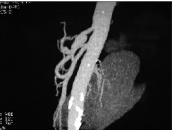 Figure 5 – CT Angiography: absence of aortic dissection