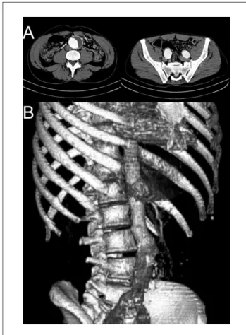 Figure  2  -  Post-EVAR  axial  (A)  and  3D  reconstruction  (B)  CT  scan,  showing adequate positioning of the endograft and no endoleak.