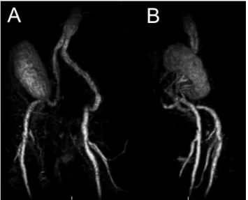 Figure 3 - Post-RT MRI-A, showing good positioning of the aorto-iliac  endograft and adequate perfusion of the renal graft.