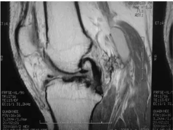 Figure  3 –  Echographic  evidence  of  arterial  low  disappearance  after  vigorous contraction of the calves