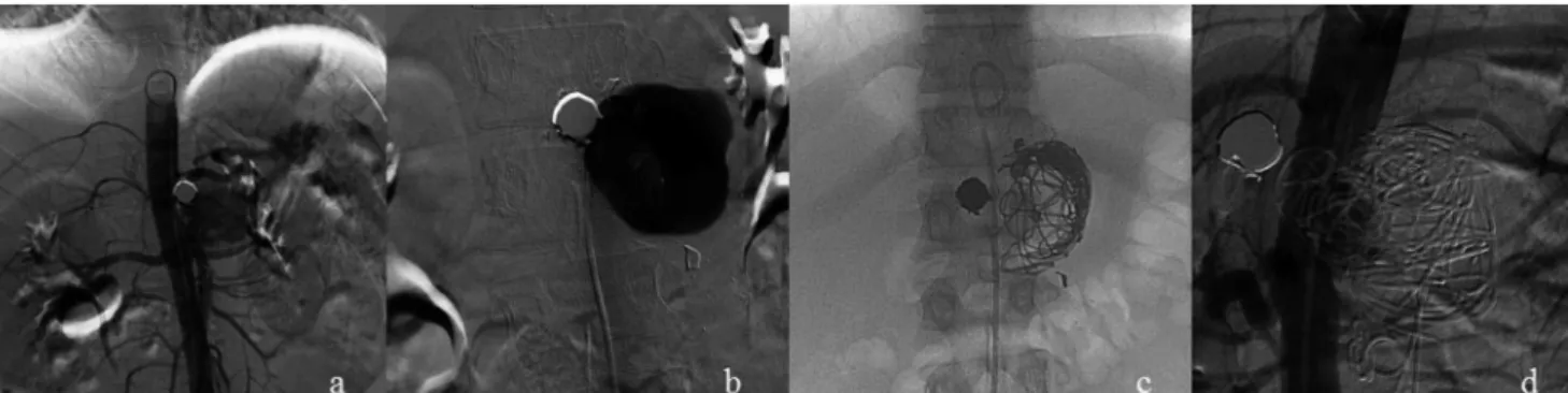 Figure 2 – Aortography showing the contrast low to the interior of the pseudoaneurysm (A); selective catheterization of the pseudoaneurysm (B); 