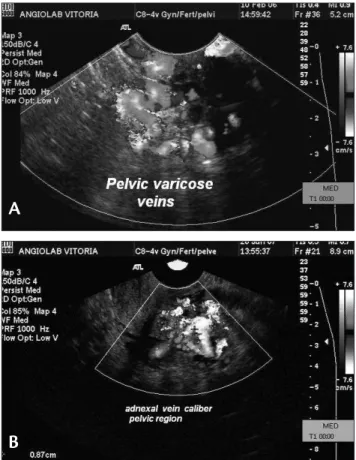 Figure 1 - A) Dilated vessels, with relux, in the adnexal region identiied  by transvaginal color Doppler ultrasound; B) measurement of adnexal  vein caliber, identiied by transvaginal color Doppler ultrasound